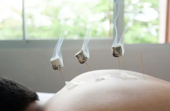 acupuncture.md